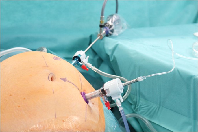 Surgical trocar for laparoscopic surgery