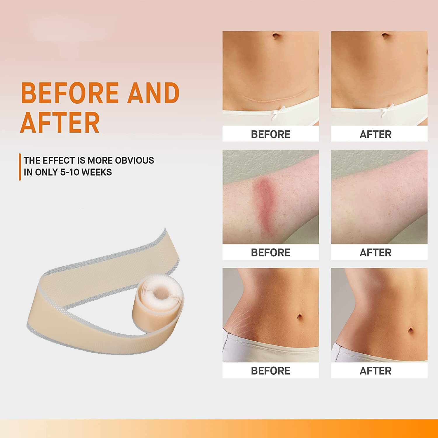 Silicone gel sheets for scars silicone scar treatment